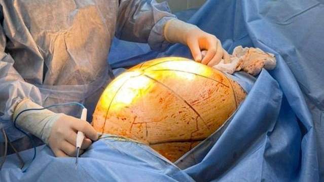 опухоль undefined